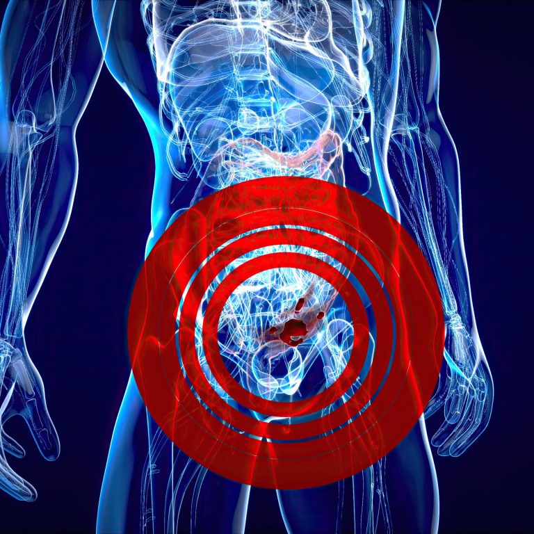 Abstract illustration of the colon cancer